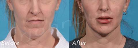 Post-Face Lift Care