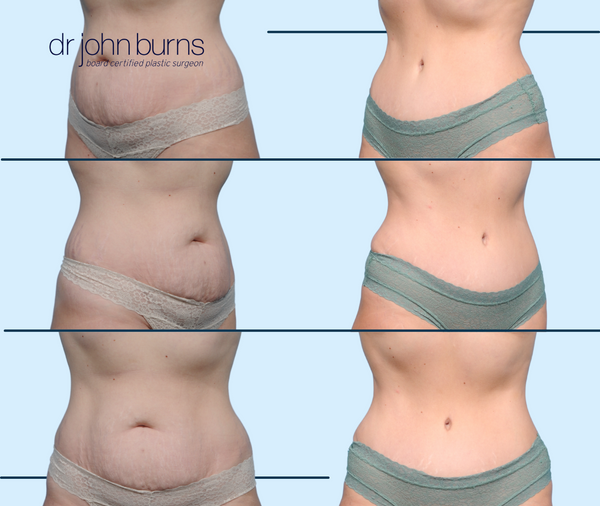 Before & After Mommy Makeover Tummy Tuck by Dallas Plastic Surgeon Dr. John Burns