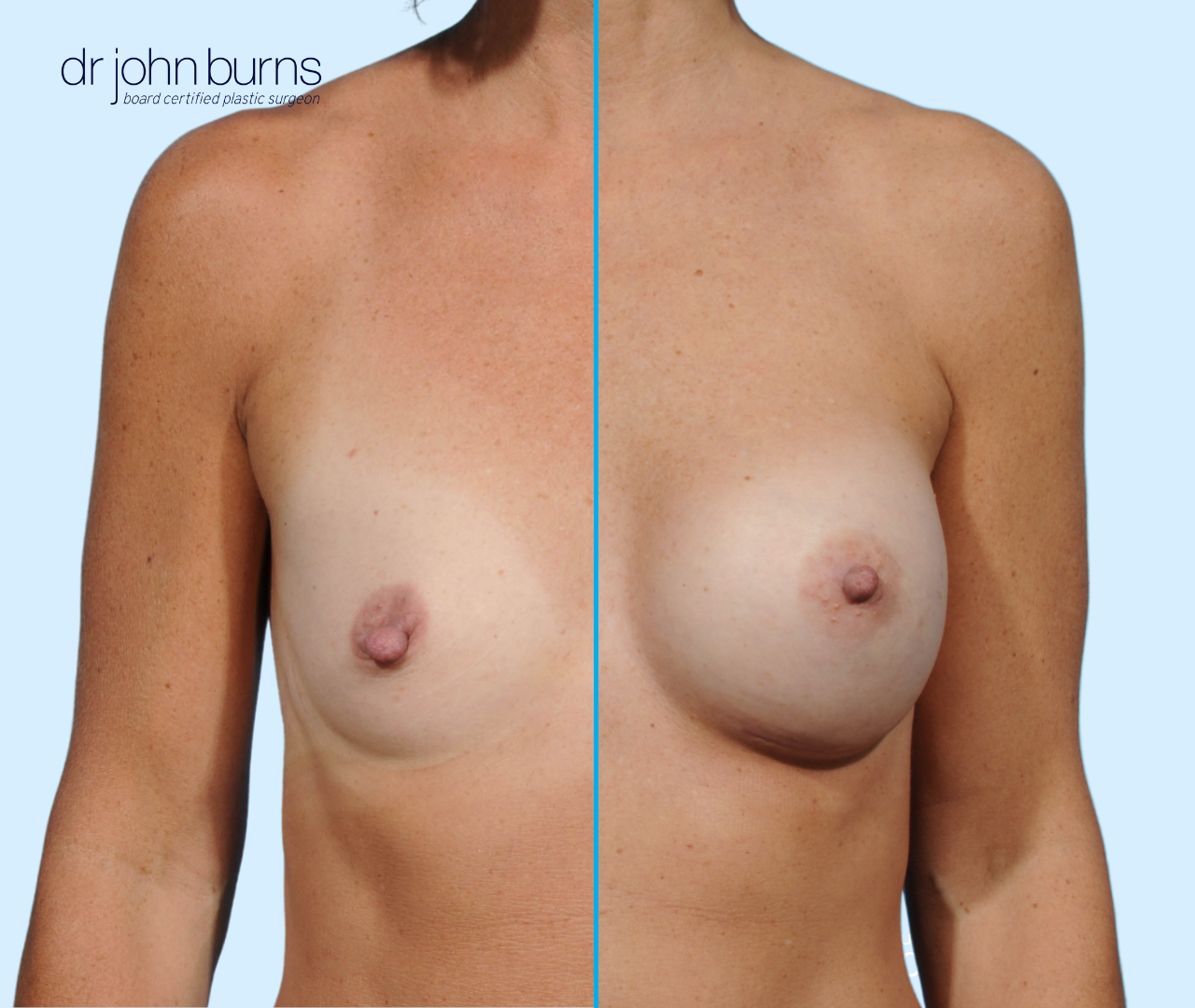 Before & After 330 cc Breast Implants by Dr. John Burns