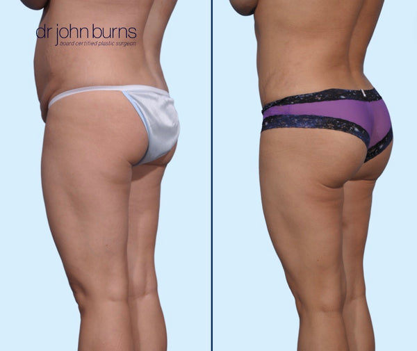 Tummy Tuck + Brazilian Butt Lift- Dallas Plastic Surgeon- Dr. John Burns –  Dr John Burns