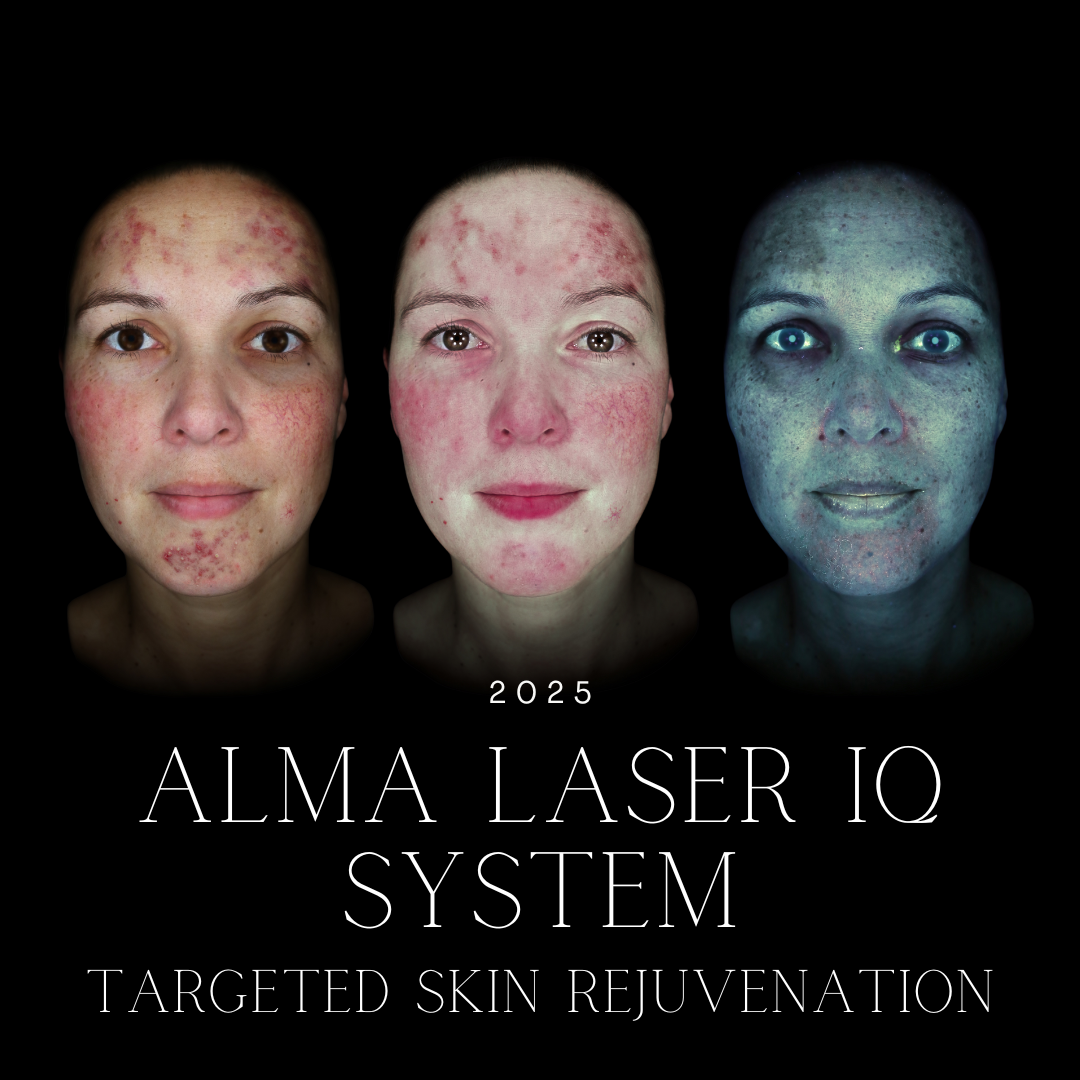 Alma Laser IQ System: Targeted Skin Rejuvenation