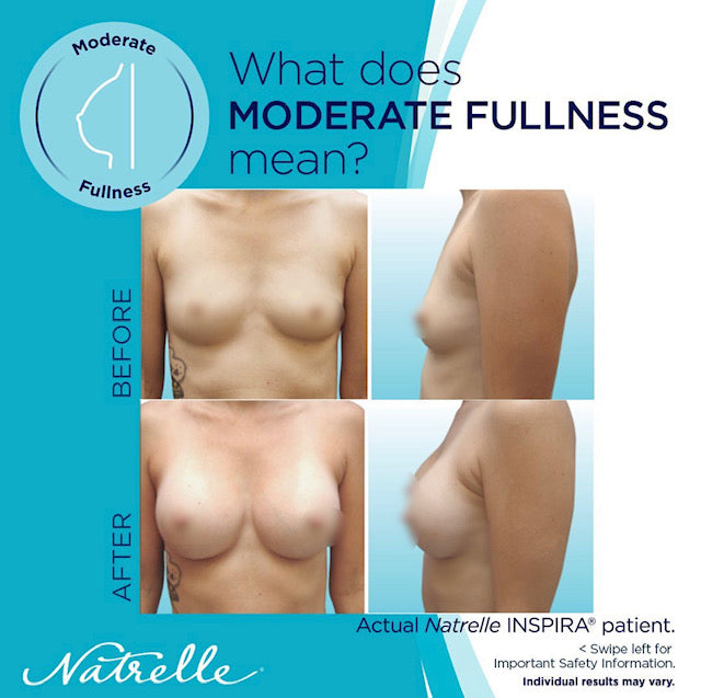 Not Too Big, Not Too Small:  Just Right:  Moderate Profile Implants