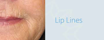 How to Treat Lip Lines