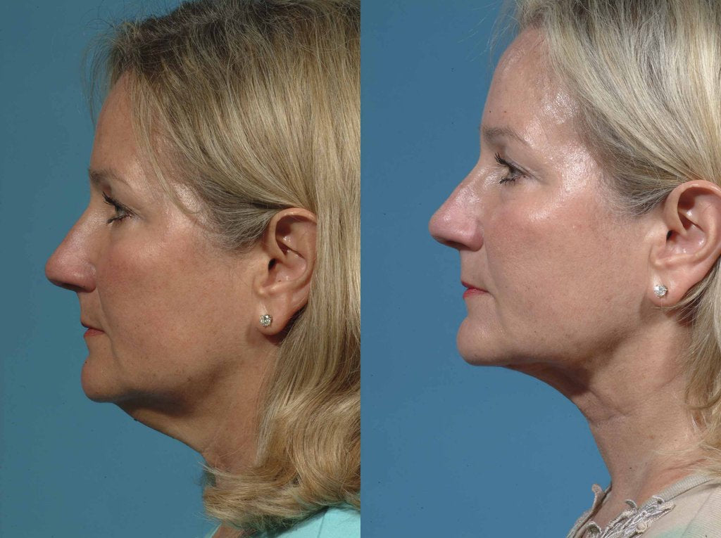 The How, What, Where and Why About Neck Lifts