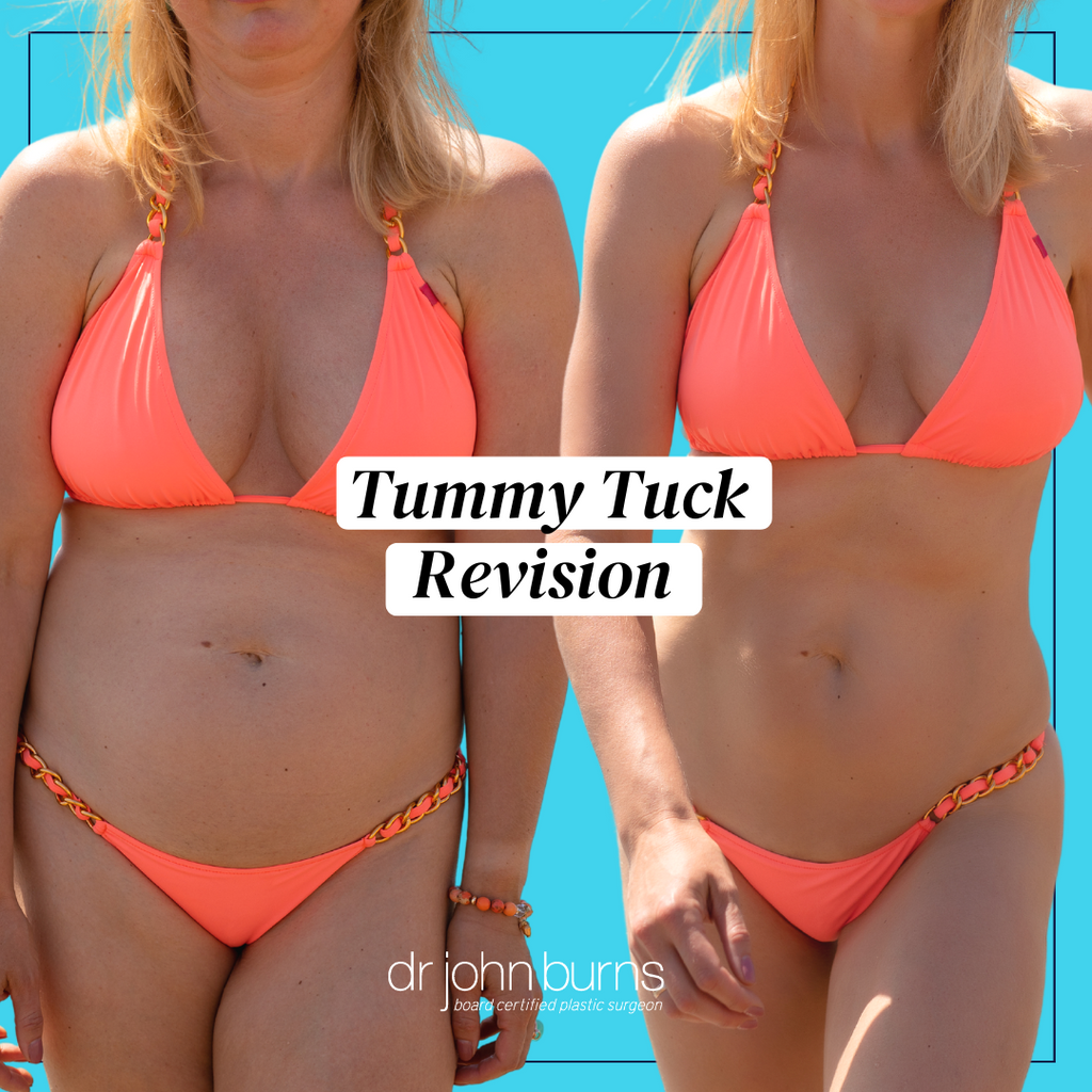 Breast Augmentation Bryn Mawr