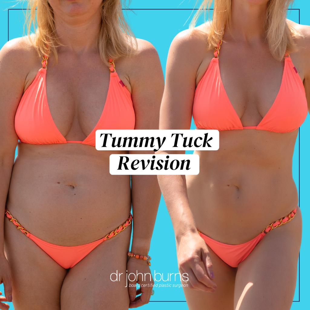 Tummy Tuck Revision