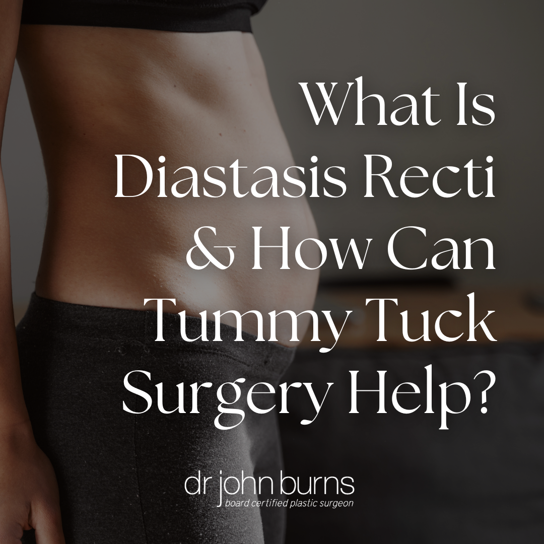What Is Diastasis Recti and How Can Tummy Tuck Surgery Help?