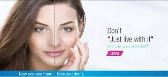 Advanced Treatment Options for Acne Scars