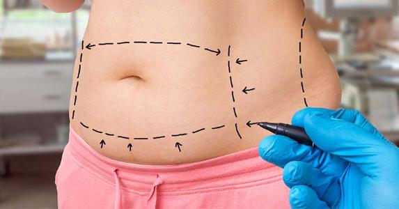 What You Should Know Before Tummy Tuck Surgery