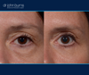 left eye view | before and after upper and lower blepharoplasty surgery 