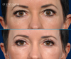 Upper eyelid surgery | before and after results by Dr. John Burns