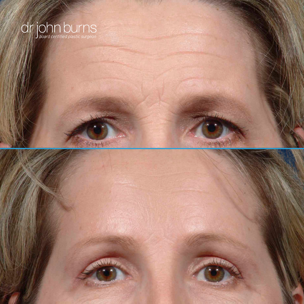 Case 3- Before and After Brow Lift