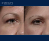 right eye view | Before and after upper eyelid surgery by Dr. John Burns