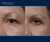 left eye view | Before and after upper eyelid surgery by Dr. John Burns
