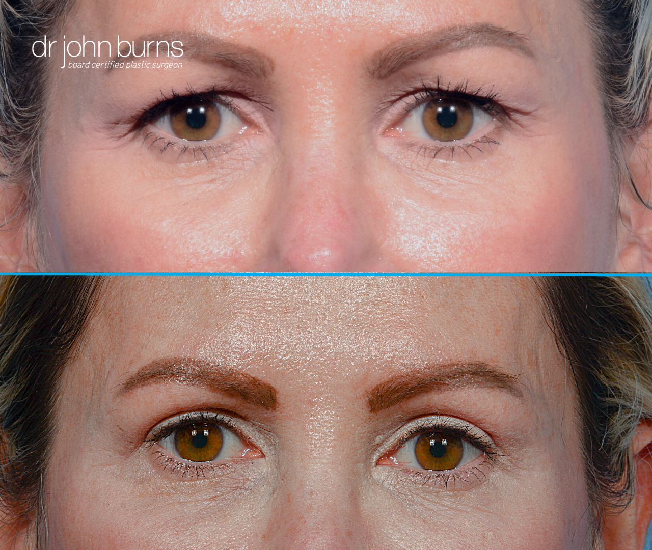 Before and After Eyelid Surgery by Dr. John Burns