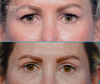 Before and After Eyelid Surgery by Dr. John Burns