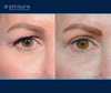 Right eye view | Before and after eyelid surgery