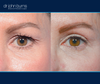Left eye view | Before and after eyelid surgery