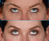 patient looking up } before and after eyelid surgery