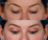 patient looking down, eyelid lift scars, before and after