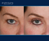 right eye view | before and after eyelid surgery
