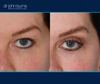 left eye view | before and after eyelid lift