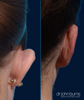 Right Posterior Ear | Before and After Otoplasty Results by Dallas Plastic Surgeon, Dr. John Burn