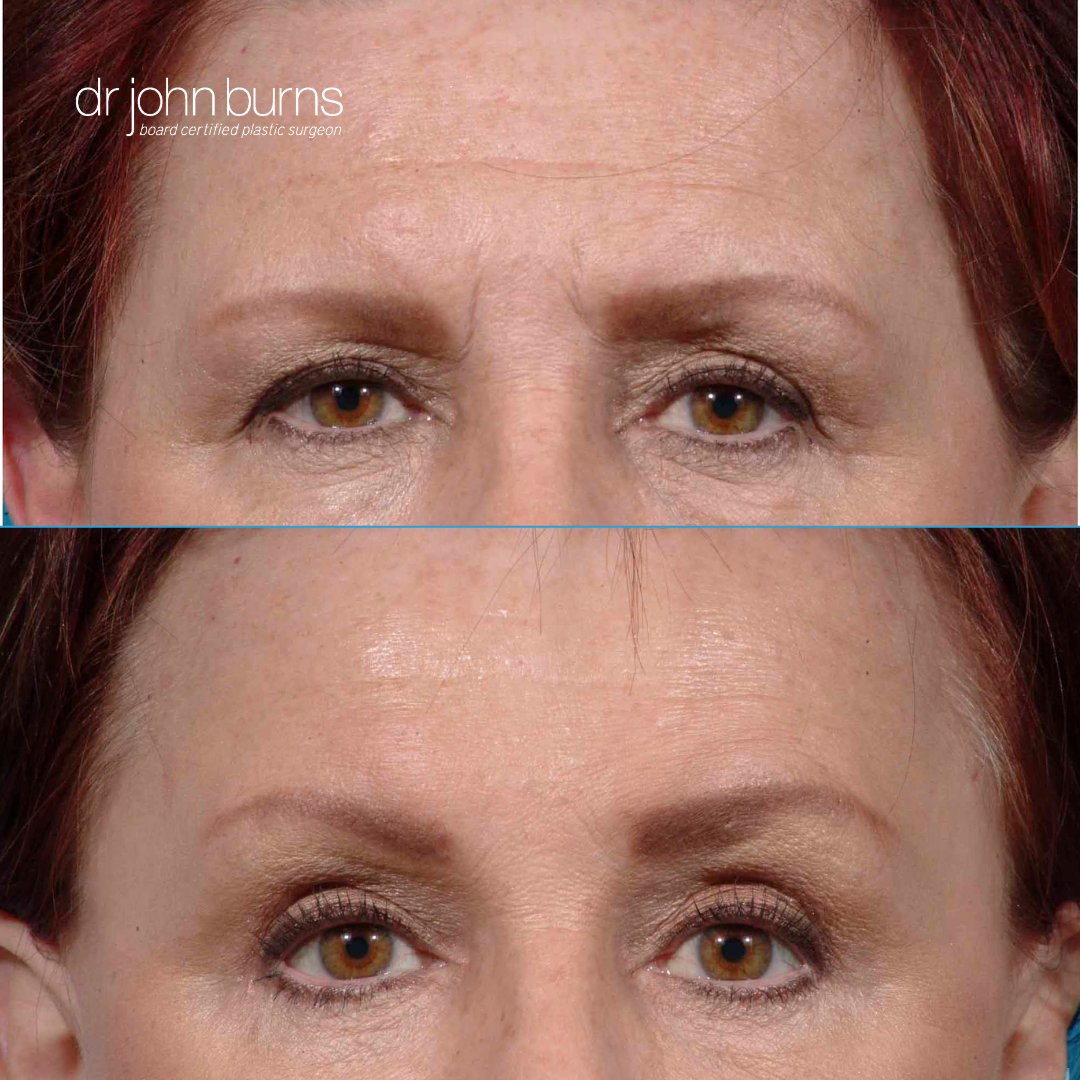 Before and After Brow Lift Surgery- Dallas Brow Lift- Dr. John Burns