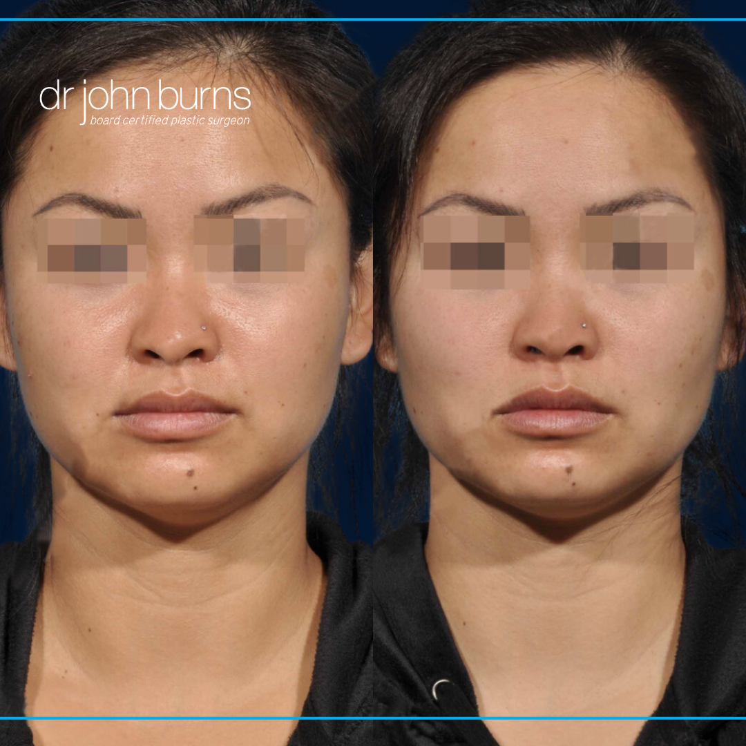 Before and After Buccal Fat Pad Removal by Dr. John Burns