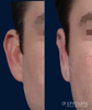 Right Ear | Before and After Otoplasty Results by Dallas Plastic Surgeon, Dr. John Burn