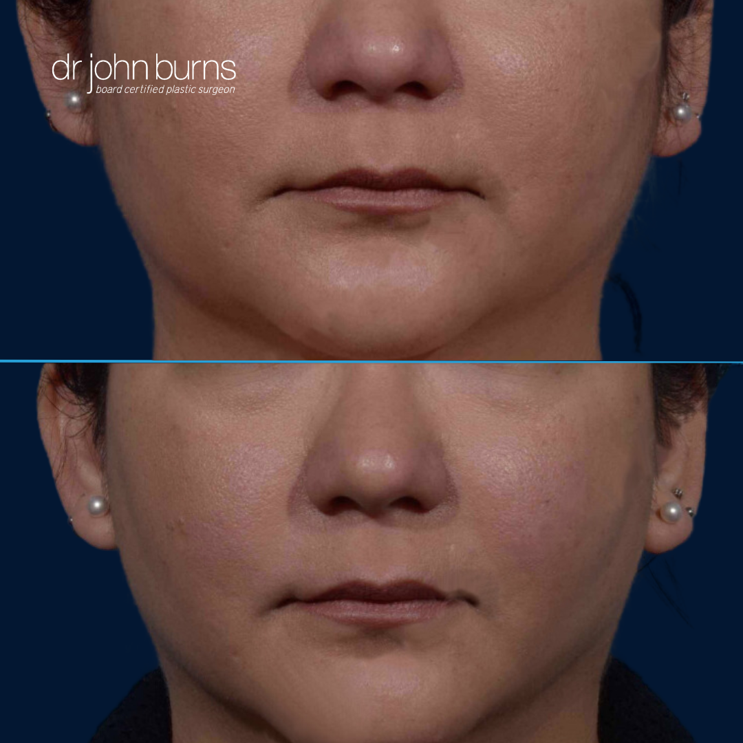 Before and after buccal fat pad removal in Dallas, Tx., by Dr. John Burns