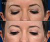 Before and after results | upper eyelid surgery, patient looking down