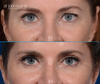 before and after upper eyelid surgery by Dr. John Burns