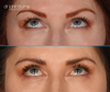 upper eyelid surgery results, patient looking up