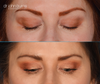 upper eyelid surgery results, patient looking down