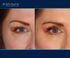 right eye view | upper eyelid surgery results