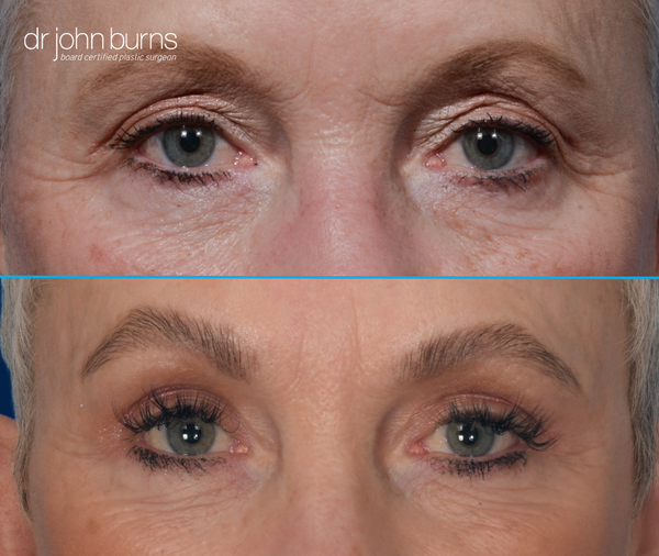 Before and after upper eyelid surgery by Dr. John Burns