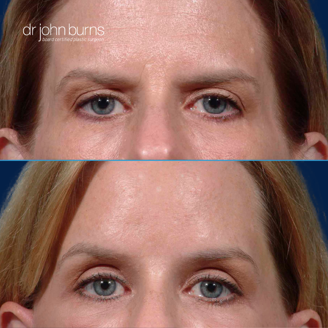 Before and After Brow Lift- Dallas Brow Lift by Dr. John Burns