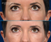 Before and after results | upper eyelid surgery