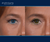 Case 9- Blepharoplasty- Eyelid Surgery