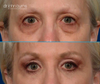 before and after upper, lower eyelid lift with canthopexy by Dr. John Burns