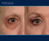 right eye, before and after eyelid lift and canthopexy 