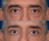 Before and After Male Upper & Lower Eyelid Surgery by Dr. John Burns