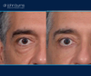 right eye view | male upper and lower eyelid surgery results