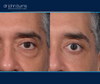 left eye view | Before and After Male Upper & Lower Eyelid Surgery by Dr. John Burns