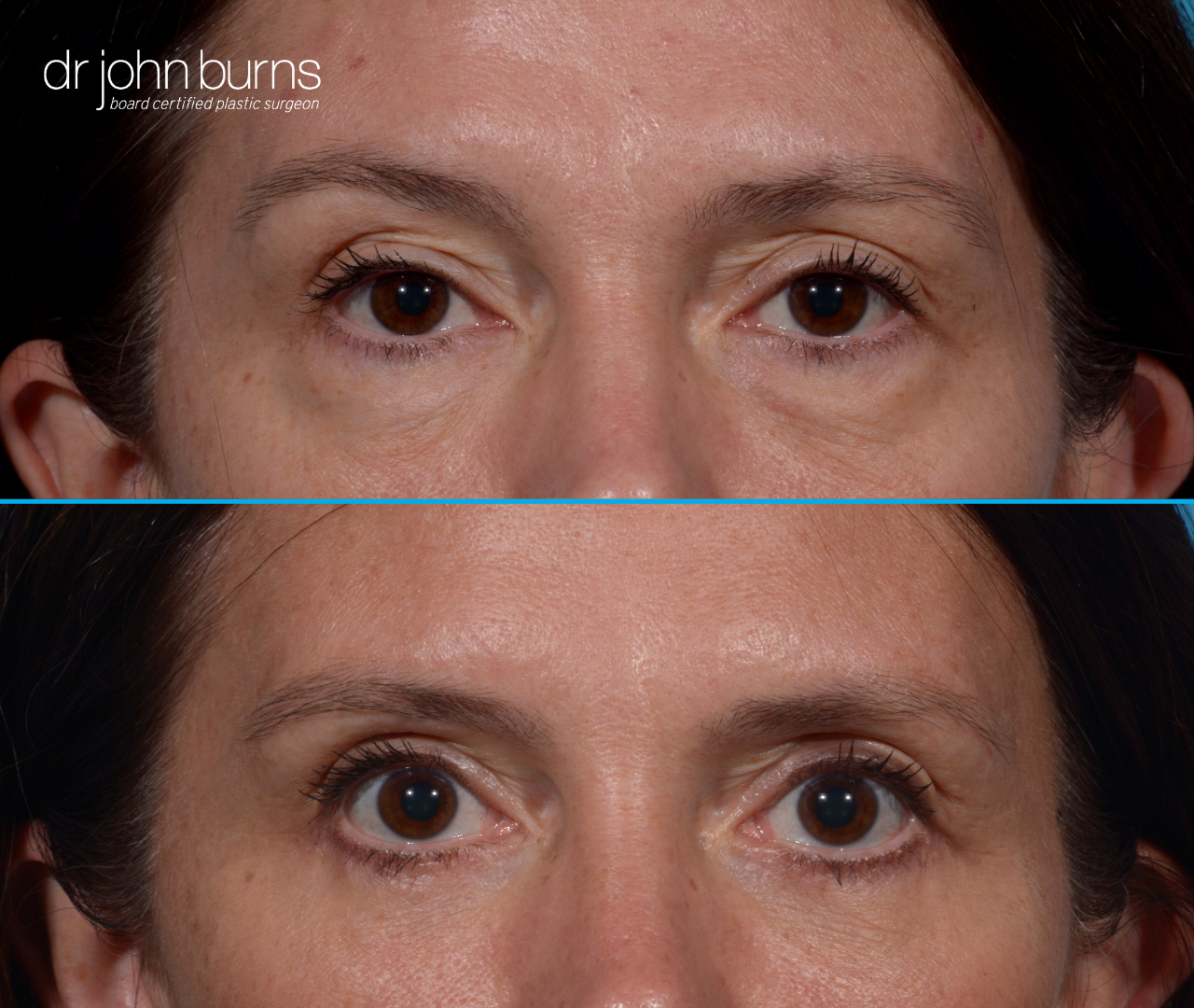 upper and lower eyelid surgery results by Dr. John Burns