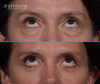 patient looking up | before and after upper and lower blepharoplasty surgery 