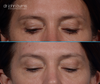 patient looking down | before and after upper and lower blepharoplasty surgery 