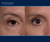 right eye view | before and after upper and lower blepharoplasty surgery 