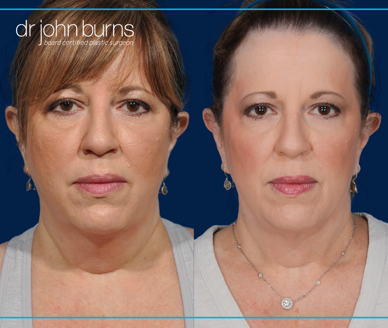 Before and After Neck Lift with Neck LIpo by Dallas Plastic Surgeon, Dr. John Burns
